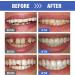 Tooth Filling Repair Kit: Temporary Tooth Kits with Moldable False Teeth - Easy to Use - White - Buy Online on GoSupps.com