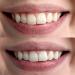 Smile Hero LED Teeth Whitening Kit - Professional At-Home Teeth Whitening Solution - Buy Online on GoSupps.com