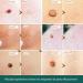 Beauty Grain Corrector | Quick Wart Removal 20ml Blemish Corrector Solution Beauty Home Travel Pre-Event Personal Toiletry Women Men - Buy Online on GoSupps.com