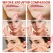 Hydrocolloid Pimple Patches for Day & Night | Invisible Acne Treatment | Breathable Skin Care Solution - Buy Online on GoSupps.com