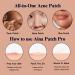 AINA Hydrocolloid Pimple Patches - Invisible Acne Spot Dots | Clear Natural Zit Patches | 48 Dots + Bonus Chin & Nose Patches - Buy Online on GoSupps.com
