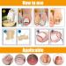 Ingrown Toenails Treatment Set | Toenail Correction Patch & Stainless Steel Foot Care Tools - Buy Online on GoSupps.com