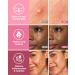 LitBear Acne Patch 112 Pcs - Black & Pink Star Hydrocolloid Absorbing Cover for Face - Tea Tree Oil + Centella - Zit & Pimple Dots - Buy Online on GoSupps.com
