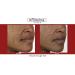 Fillerina Dermo Cosmetic Filler Treatment Grade 2 - Buy Online on GoSupps.com