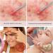 Titanium Blackhead Removal Acne Needle Blasting ToolFacial Acne RemoverTitanium Teardrop Acne Needles 2 Pcs with Iron Case - Buy Online on GoSupps.com
