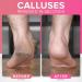 RUSTPROOF Callus Remover for Feet | XL Professional Pedicure Foot File & Spa Products | Effective Wet & Dry Dead Skin Scrubber - Non-Electric Foot Care Kit - Buy Online on GoSupps.com