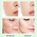 Azelaic Acid Cream Azelaic Acid Serum Cream 14% Azelaic Acid Serum Face Cream with Niacinamide & Vitamin C Anti Redness Cream Reduce Blemishes Remove Acne&Rosacea Shrink Pore for All Skin Types - Buy Online on GoSupps.com