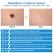 Kolarmo 2-in-1 Micro-Rag Remover Set | Pain-Free Wart Acne & Skin Tag Removal Internationally - Buy Online on GoSupps.com