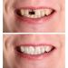 Jiazhou Hub 2 Pairs Prostheses - High-Quality Fake Teeth & Immediate Veneers for a Stunning Smile - Buy Online on GoSupps.com