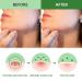 Hydrocolloid Acne Blemish Patch Fast Healing for Clear Skin | International Shipping Available - Buy Online on GoSupps.com