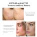 Murad InvisiScar Resurfacing Treatment 1 Fl Oz - Reduce Acne Scars & Dark Spots - Buy Online on GoSupps.com