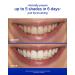 Supersmile Original Mint Whitening Kit - Enhance Your Smile | International Shipping Available - Buy Online on GoSupps.com