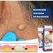 Cr me Naturelle d' limination des Lipomes Cr me d' limination des Lipomes Cr me pour l' limination des Lipomes Cr me D' limination des Lipomes V g taux Lipoma Removal Cream 20g 2PC - Buy Online on GoSupps.com