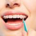 LOVEWEE Dental Elastic Bands Placers for Braces - 20PCS Disposable Orthodontic Placers - Multi-color - Pack of 1 - Buy Online on GoSupps.com