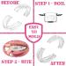 GRINDSHIELD Bruxism Mouth Guard - Smaller Size, Moldable & Custom Fit - Set of 4 with Case | Dental Guard for Teeth Grinding, Clenching & TMJ Relief - Buy Online on GoSupps.com
