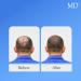 MD Hair Restoration Two Step System - Follicle Activator & Energizer for Hair Thinning Regrowth & Nourishment | Ideal for Men & Women - International Shipping Available - Buy Online on GoSupps.com