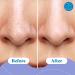 Buy Blackhead Remover & Pore Minimizer Kit - 10 Nose Strips Exfoliating Swabs 1oz Toner - Natural Ingredients for Clear Skin - Buy Online on GoSupps.com
