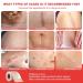 Silicone Scar Roll Sheet 1.6 x 3m - Extra Long & Reusable Professional Scar Removal for C-Section Tummy Tuck Keloid Burn Acne - Buy Online on GoSupps.com
