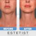 ESTETIST V Shaped Slimming Face Mask - Double Chin Reducer & Face Lift Tape - Anti-Aging Firming Mask for Jawline - 5 Pack - Buy Online on GoSupps.com