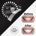 Aquasonic Teeth Whitening Strips - Dentist-Quality, Fast & Effective Results - Buy Online on GoSupps.com