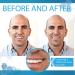 Instant Smile Tooth Replacement Kit - Complete Your Smile in Minutes - Patented Solution - Buy Online on GoSupps.com