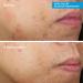 Murad Deep Relief Blemish Treatment - Blemish Control - Max Strength 2% Salicylic Acid Healing Treatment for Deep Uncomfortable Cystic Blemish - 30ml - Buy Online on GoSupps.com