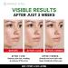 Acne Medication Face Cream - Fast Acting USA-Made Treatment for Stubborn Pimples, Blackheads, Whiteheads - Soothing Moisturizer for Acne Relief & Scar Prevention - 2oz - Buy Online on GoSupps.com