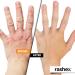Rashex Eczema & Psoriasis Treatment Ointment | Black Ichthammol 20% | Fast Relief | 2 Oz Tube - Buy Online on GoSupps.com