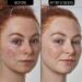 The Inkey List Azelaic Acid 10% Serum 30ml | Targets Redness | Fragrance-free | All Skin Types - Buy Online on GoSupps.com
