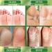 Urea 40% Foot Cream - Urea Cream for Feet - Foot Cream for Cracked Heels and Dry Skin - Cracked Heel Repair Cream with Hyaluronic Acid and Aloe Vera - Foot Cream for Very Dry Feet - Buy Online on GoSupps.com