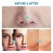Razor Bump Stopper & Dark Spot Remover: Ingrown Hair Treatment for Men & Women - Buy Online on GoSupps.com