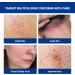 Folliculitis & Acne Treatment Cream Salicylic Acid & Herbal Extracts for Scalp Face Body & Back Soothes Irritated Skin Redness & Itch Relief 100g (Pack of 1) 3.4 Fl Oz (Pack of 1) - Buy Online on GoSupps.com