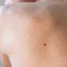 Naturasil Cherry Angiomas 10ml | Shop Liquid Roller for Effective Skin Treatment Worldwide - Buy Online on GoSupps.com