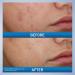 CeraVe Acne Foaming Cream Wash - 10% Benzoyl Peroxide Acne Cleanser Hyaluronic Acid & Niacinamide | Treats Pimples Blackheads & Body Acne - 5 Oz - Buy Online on GoSupps.com