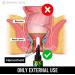 Hemorrhoid Treatment Cream Gel | Fast-Acting Pain Relief | Made in USA | 5% Lidocaine | Heal Fissures - Buy Online on GoSupps.com