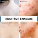 Acne Treatment Soap Bar with Salicylic Acid | Antifungal Medicated Soap for Body Face & Back | Natural Essential Oil Dark Spot Remover - Buy Online on GoSupps.com