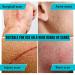 Silicone Scar Tape - Medical Grade Silicon Sheets for Hypertrophic and Keloidal Scars Treatment - Skin Color - Buy Online on GoSupps.com