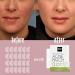 Hydrocolloid Large Acne Patches - 80 Pieces for Cheek & Chin | Conceal Breakouts & Reduce Pimples & Blackheads | International Shipping Available - Buy Online on GoSupps.com