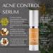 RD Alchemy Acne Control Serum - 100% Natural & Organic Face Serum for Oily & Combination Skin | Best for Acne & Blemishes - Buy Online on GoSupps.com
