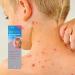 Care ViraSoothe Chickenpox Relief Cooling Gel 75g - Soothes & Cools Skin | Pack of 1 - Buy Online on GoSupps.com