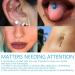 Natural Ear Wax Removal Spray - Safe & Effective Cochlear Blockage Remover (3pcs) - Buy Online on GoSupps.com