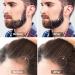 540 Titanium Derma Roller for Beard & Body Hair Growth | Home Use Microneedle Roller with Storage Case - Buy Online on GoSupps.com
