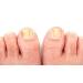 VIT 20 Antifungal Brush-on 0.5 oz - Fast-Acting Treatment for Fungal Infections - Buy Online on GoSupps.com