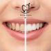 SmileVegan - Pro Whitening Serum - Teeth Whitening Kit - White Smile - Color Corrector - White Teeth - Alternative Teeth Whitening Strips - Buy Online on GoSupps.com