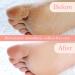 Pedi Peach Professional Electric Foot Scraper - Callus & Corn Remover for Dead Skin - Portable Pedicure Kit - Buy Online on GoSupps.com