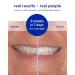 Supersmile Dissolving Superstrips | Professional Enamel Safe Teeth Whitening Strips for Sensitive Teeth - Shop Now - Buy Online on GoSupps.com