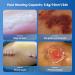 Hydrocolloid Wound Dressings - 10cm x 10cm 10 Pcs | Large Waterproof Support for Pressure Ulcers Burns & Quick Healing - Ourmed - Buy Online on GoSupps.com