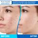 AOBBIY Azelaic Acid Cream: Azelaic Acid For Face - Premium Azelaic Acid Cream - Face Skin and Beauty Care - Azelaic Acid Facial Cream (1 Oz) - Buy Online on GoSupps.com