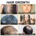 Buy Hair Growth Foam for Men & Women | With Biotin & Capilia Longa | Effective Hair Regrowth Treatment for Thicker Stronger Hair | Stop Hair Thinning - Buy Online on GoSupps.com