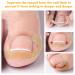 Xinzan 2 Types Ingrown Toenail Treatment Patch with Ingrown Toenail Tool Professional Ingrown Toenail Corrector Tools for Toenail Care Protect Toe Nail - Buy Online on GoSupps.com